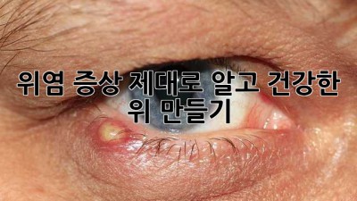 위염 증상, 제대로 알고 건강한 위 만들기